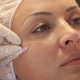 Мезотерапия на лицето: какво е това и как се провежда?